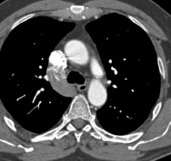 Interruption of IVC With Duplication of IVC in Abdomen - CTisus CT Scan