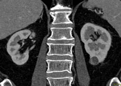 1 Cm Subtle Left Renal Cell Carcinoma (RCC) - CTisus CT Scan