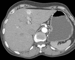 Renal Cell Carcinoma With Liver and Pancreatic Metastases - CTisus CT Scan
