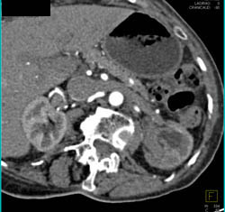 Transitional Cell Carcinoma - CTisus CT Scan