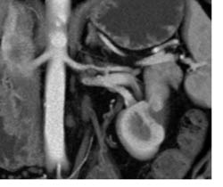 Left Renal Artery Stenosis With Plaque and Infarct - CTisus CT Scan
