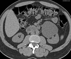 Ureteropelvic Junction (UPJ) Obstruction Due to A Crossing Vessel - CTisus CT Scan