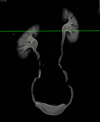 Ct Urogram - CTisus CT Scan