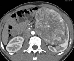 Unusual Renal Mass- RSNA Film Panel 2008 Diagnosis of Fibrous Tumor of the Kidney - CTisus CT Scan