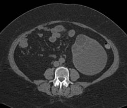 Mest- Mixed Epithelial and Stromal Tumor - CTisus CT Scan