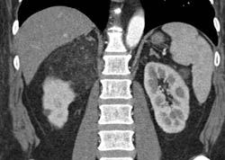 Renal Angiomyolipoma (AML) - CTisus CT Scan