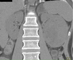 Vascular Renal Cell Carcinoma Invades the Renal Vein - CTisus CT Scan