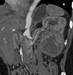 Renal Cell Carcinoma With Neovascularity and Renal Vein Involvement - CTisus CT Scan