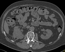 Perinephric Stranding and Transitional Cell Cancer (TCC) - CTisus CT Scan