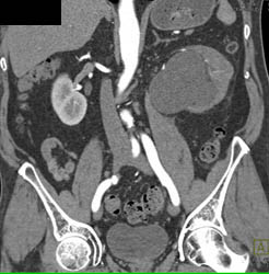 Parapelvic Cyst Left Kidney - CTisus CT Scan