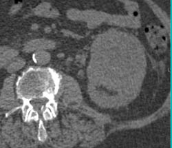 Renal Cell Carcinoma With Neovascularity- Multiphase Imaging- and Av Shunting - CTisus CT Scan