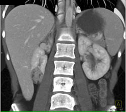 Renal Angiomyolipoma (AML) - CTisus CT Scan