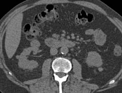 High Density Renal Cyst - CTisus CT Scan
