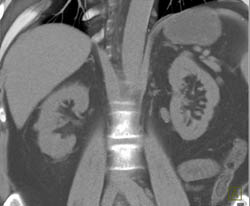 High Density Renal Cyst - CTisus CT Scan