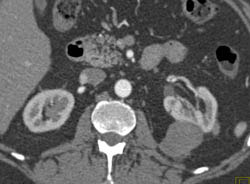 High Density Renal Cyst - CTisus CT Scan