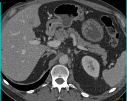 High Density Renal Cyst - CTisus CT Scan