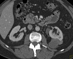 High Density Renal Cyst - CTisus CT Scan
