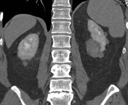 High Density Renal Cyst - CTisus CT Scan