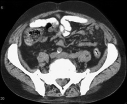 Extramedullary Disease - CTisus CT Scan