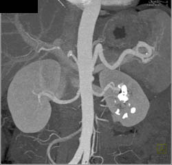 Renal Artery Aneurysm - CTisus CT Scan