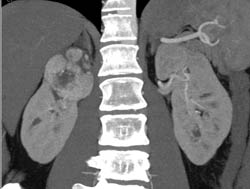 Renal Cell Carcinoma - CTisus CT Scan