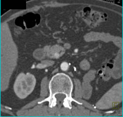 Left Nephrectomy With Recurrence in Pancreas - CTisus CT Scan
