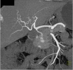 Metastatic Renal Cell Cancer to the Liver and Pancreas - CTisus CT Scan