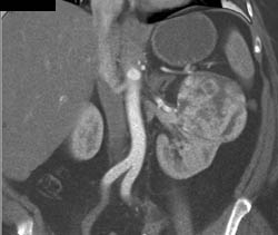 Renal Cell Carcinoma - CTisus CT Scan