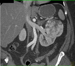 Renal Cell Carcinoma - CTisus CT Scan