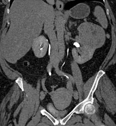 Renal Cell Carcinoma - CTisus CT Scan