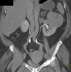 Renal Cell Carcinoma - CTisus CT Scan