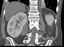 Striated Nephrogram - CTisus CT Scan