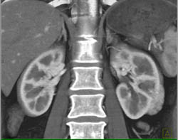 Renal Cell Carcinoma - CTisus CT Scan