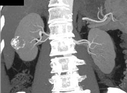 Calcified Renal Cyst - CTisus CT Scan