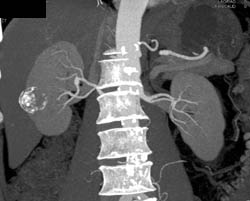 Calcified Renal Cyst - CTisus CT Scan