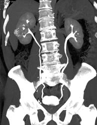 Calcified Renal Cyst - CTisus CT Scan