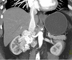 Paraganglioma Simulates Adrenal Neoplasm - CTisus CT Scan