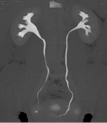 Normal CT Urogram - CTisus CT Scan