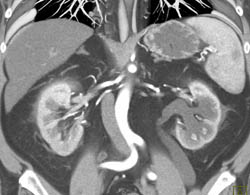Left Hydronephrosis Due to Fistula Obstruction - CTisus CT Scan