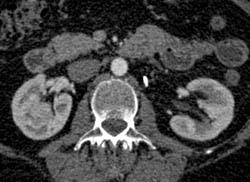 Subtle Renal Cell Carcinoma Right Kidney - CTisus CT Scan
