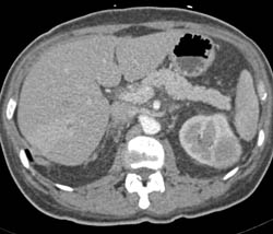 Acute Pyelonephritis - CTisus CT Scan