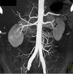 Normal Renal Arteries - CTisus CT Scan