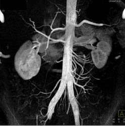 Normal Renal Arteries - CTisus CT Scan