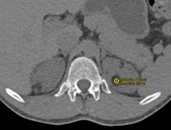 Multiple Renal Angiomyolipomas (AMLs) in Tuberous Sclerosis - CTisus CT Scan
