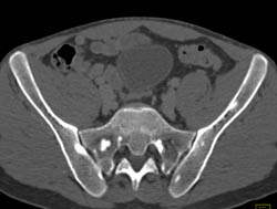 Bone Lesions and Lung Cysts in Tuberous Sclerosis - CTisus CT Scan