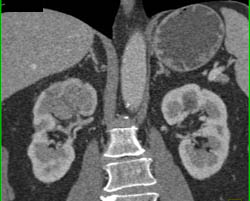 Acute Pyelonephritis - CTisus CT Scan