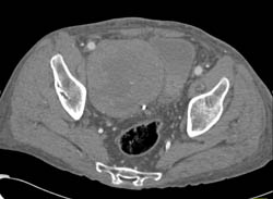 Rejected Transplant Kidney - CTisus CT Scan
