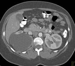 Duplicated Upper Pole Right Kidney - CTisus CT Scan