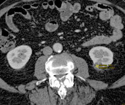 1 Cm Renal Cell Carcinoma - CTisus CT Scan
