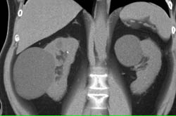 Complex Right Renal Cyst With Calcification - CTisus CT Scan